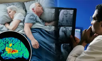 Yuxusuzluq və şəkərli diabet tez-tez Alzeymer xəstəliyindən əvvəl baş verir