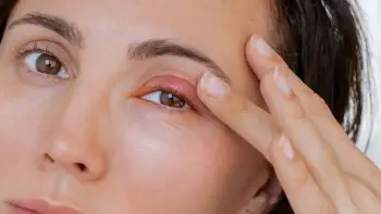 Mütəxəssislər hansı hallarda göz qapaqları və əzələlərin seğirməsinin təhlükəli ola biləcəyini açıqlayıblar