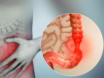 Yoğun bağırsaq xərçəngi cavanlaşır: riski necə azaltmaq olar?!